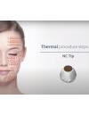 Đầu Thermal NC TIP  Dùng Cho Máy Thầm Mỹ  Duet RF.